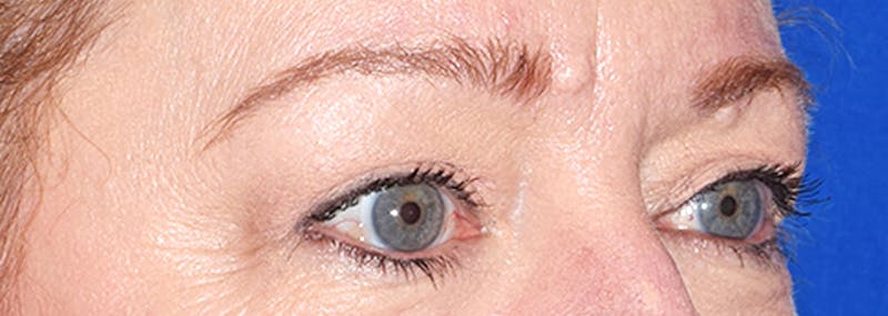 Upper Blepharoplasty Before & After Gallery - Patient 401527 - Image 4