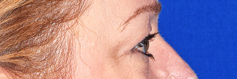 Upper Blepharoplasty Before & After Gallery - Patient 401527 - Image 6