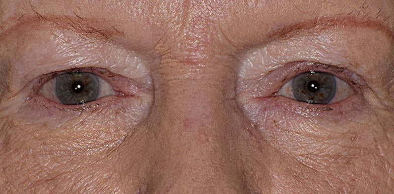 Upper Blepharoplasty Before & After Gallery - Patient 281427 - Image 1