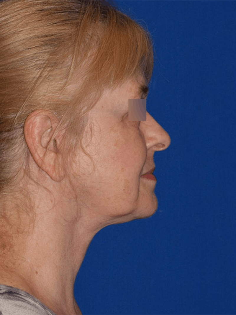 Facelift Before & After Gallery - Patient 154116 - Image 6