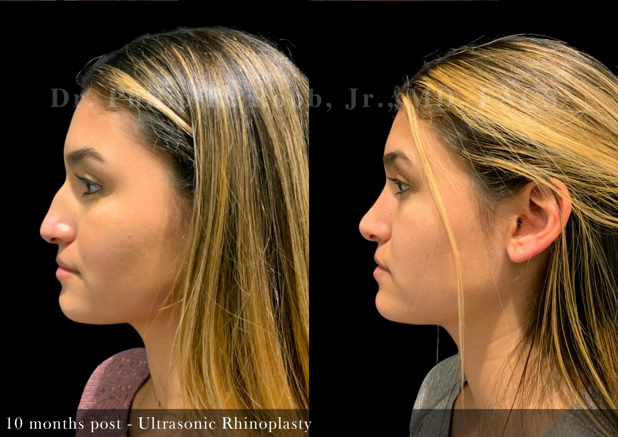 Ultrasonic Rhinoplasty Before & After Gallery - Patient 277055 - Image 5