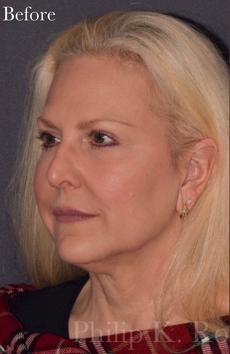 Facelift Before & After Gallery - Patient 106452 - Image 3
