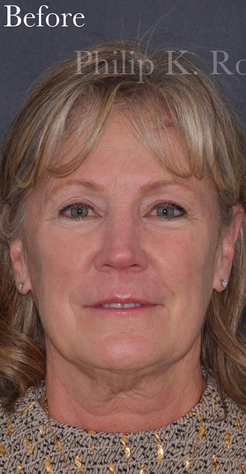 Facelift Before & After Gallery - Patient 313645 - Image 1