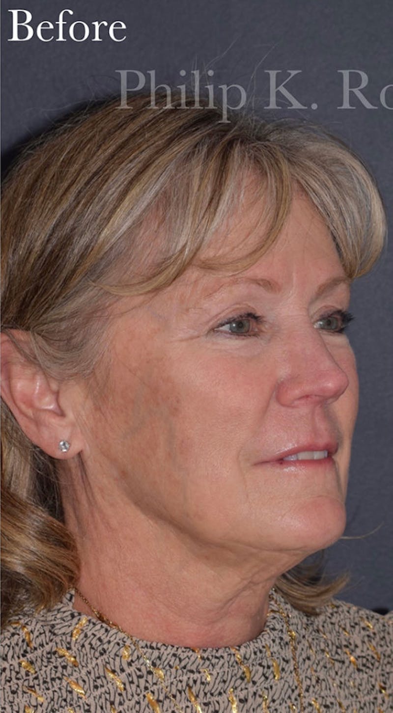 Facelift Before & After Gallery - Patient 313645 - Image 3