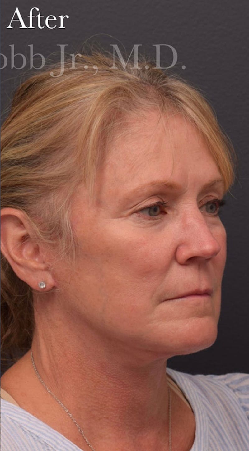 Facelift Before & After Gallery - Patient 313645 - Image 4
