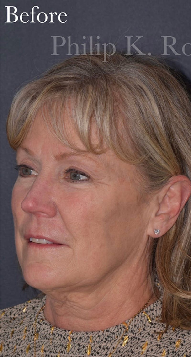 Facelift Before & After Gallery - Patient 313645 - Image 7