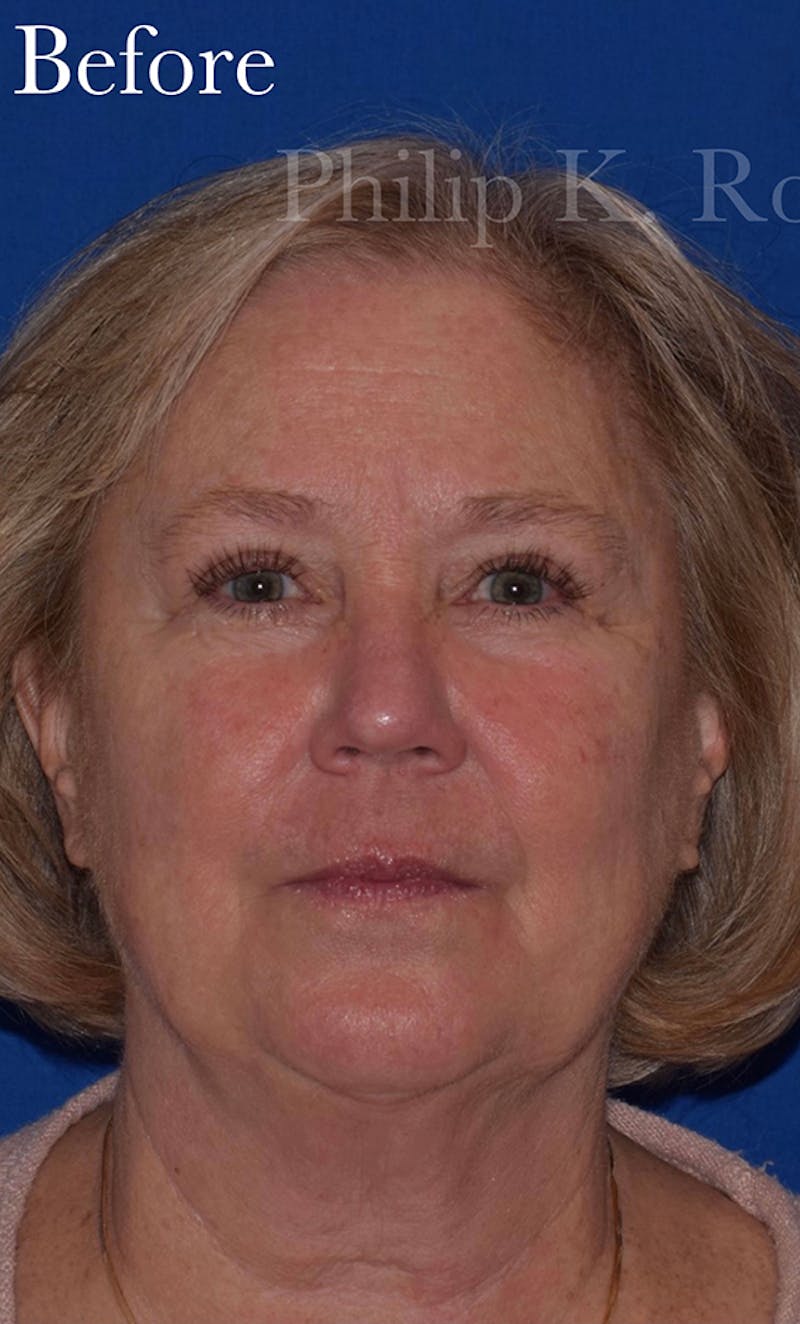 Facelift Before & After Gallery - Patient 352312 - Image 1