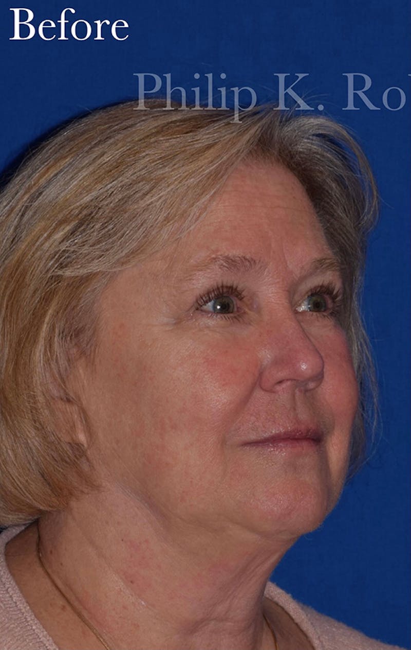 Facelift Before & After Gallery - Patient 352312 - Image 3
