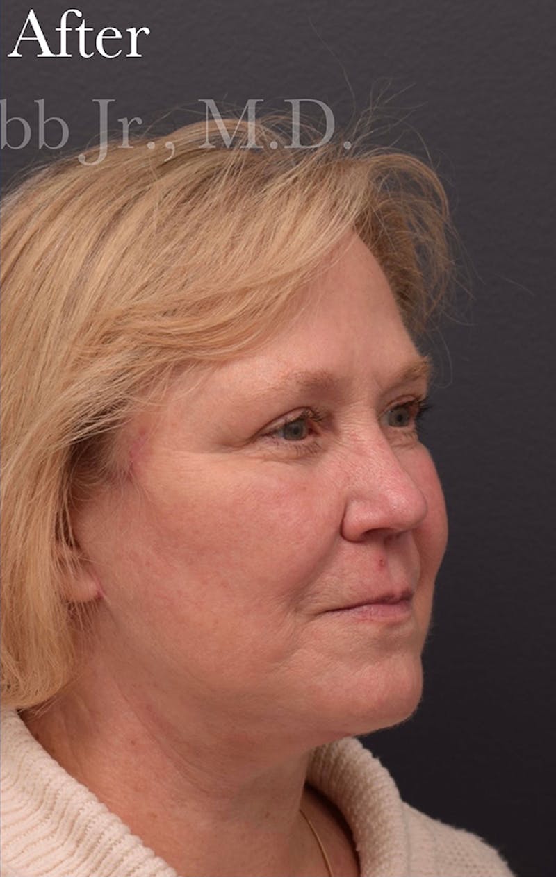 Facelift Before & After Gallery - Patient 352312 - Image 4