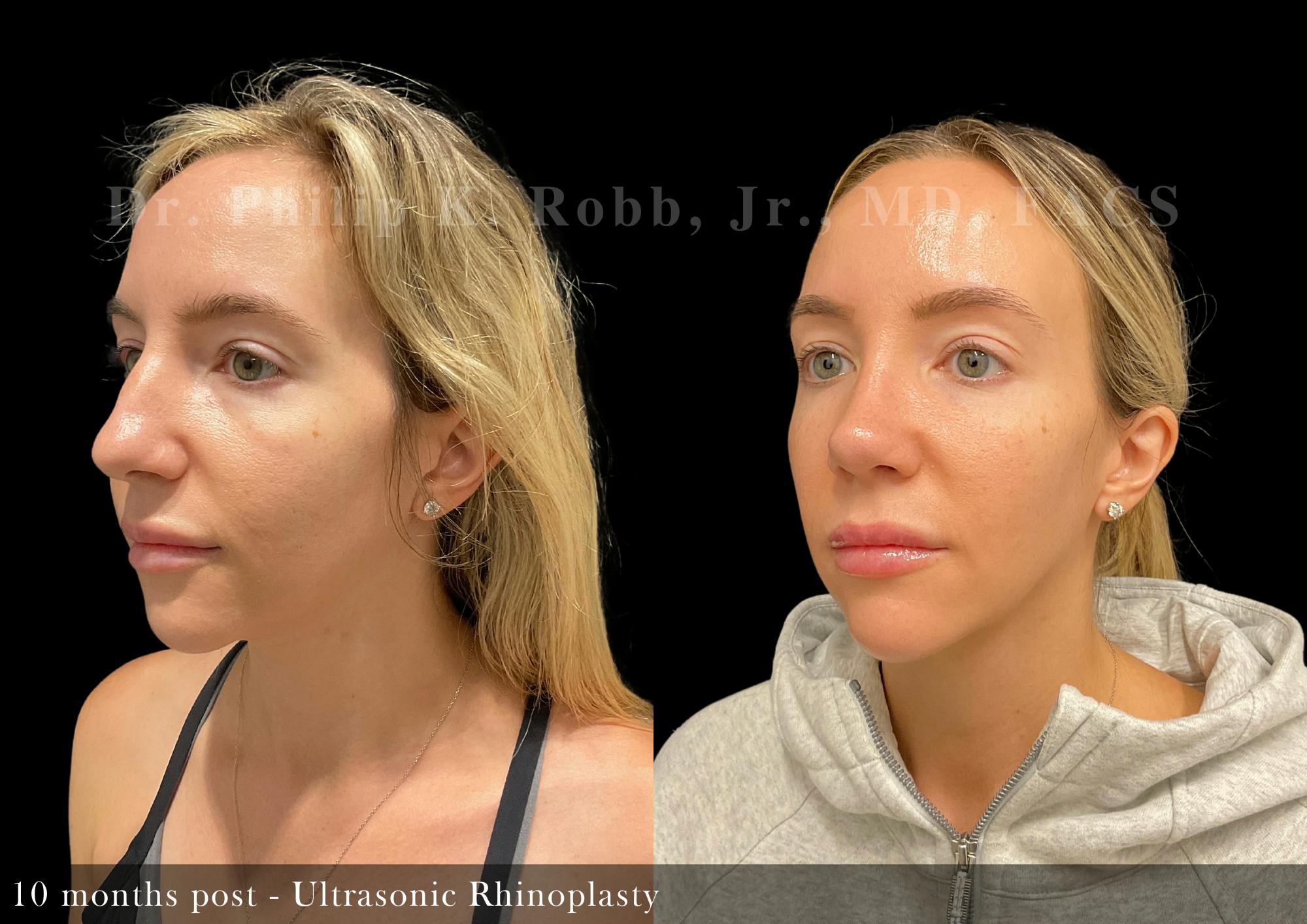 Ultrasonic Rhinoplasty Before & After Gallery - Patient 223968 - Image 5