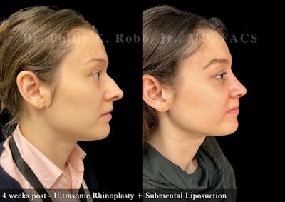 Ultrasonic Rhinoplasty Before & After Gallery - Patient 914736 - Image 1
