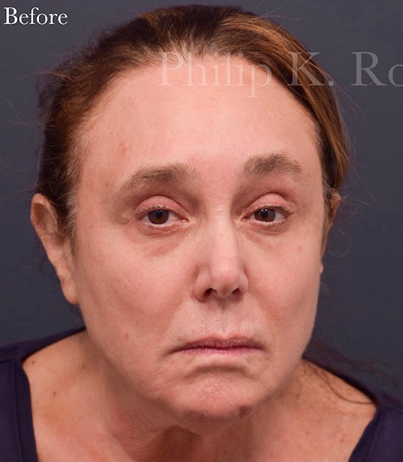 Facelift Before & After Gallery - Patient 248779 - Image 1