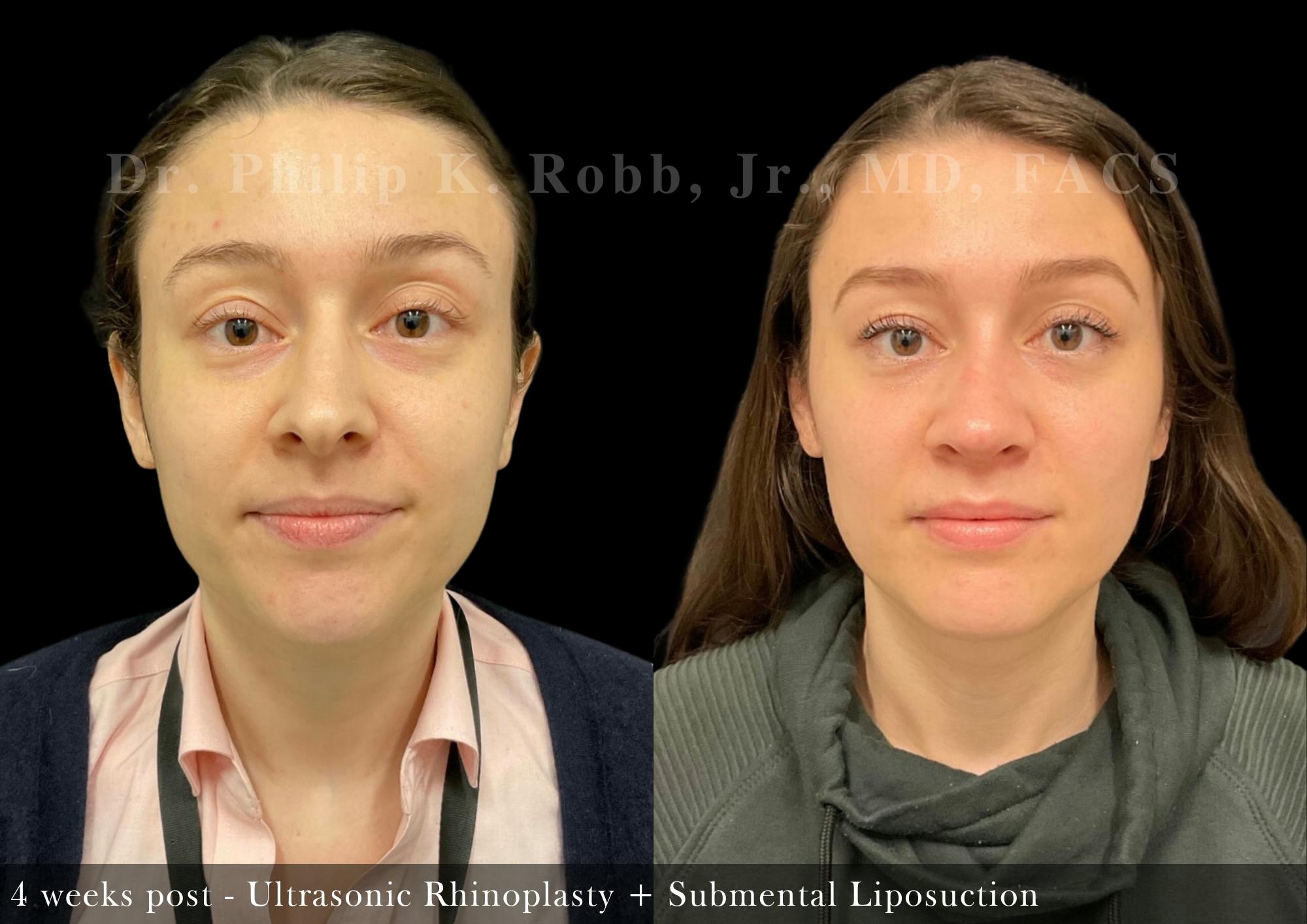 Ultrasonic Rhinoplasty Before & After Gallery - Patient 914736 - Image 3