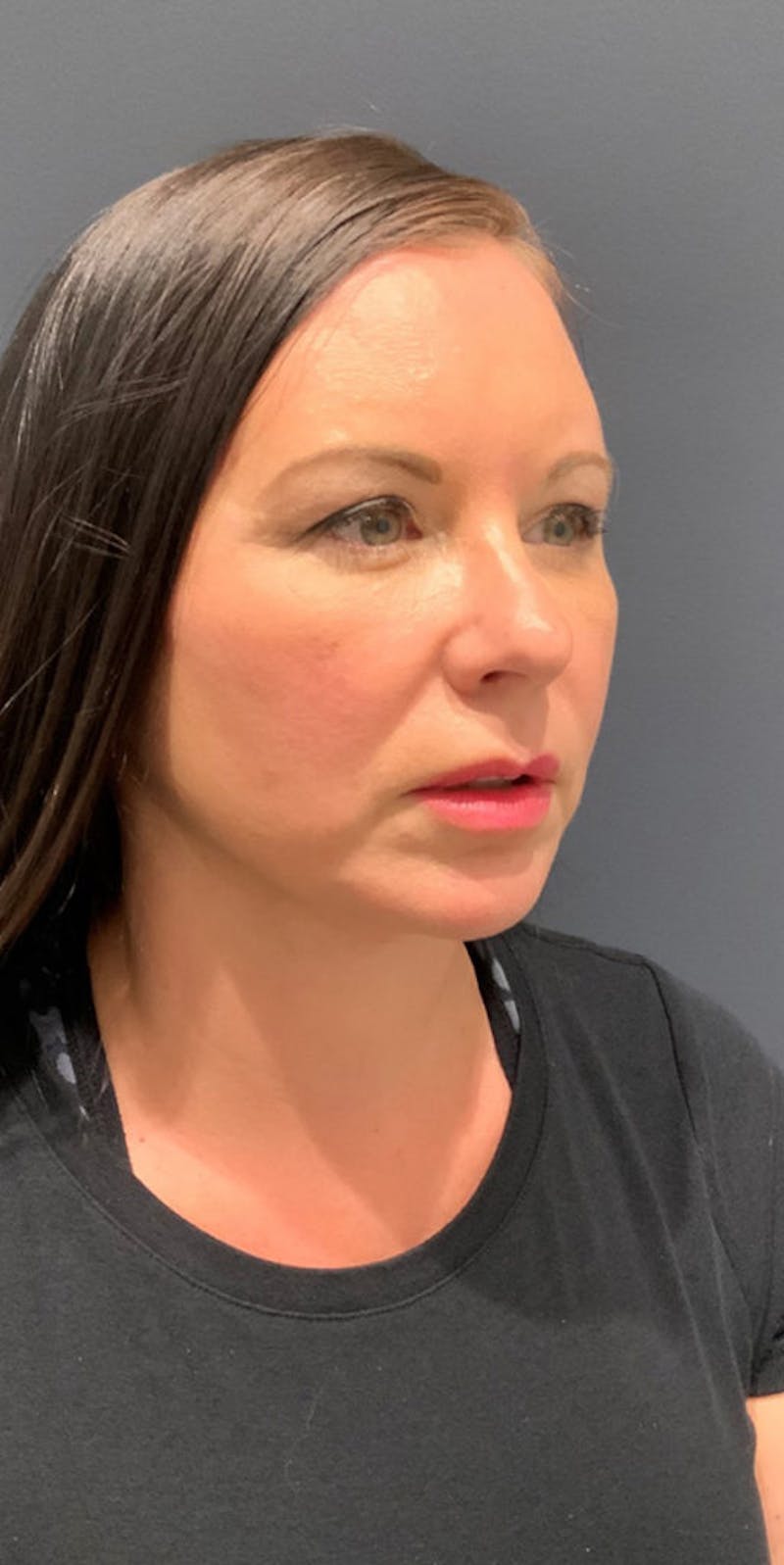 Facelift Before & After Gallery - Patient 147715 - Image 2