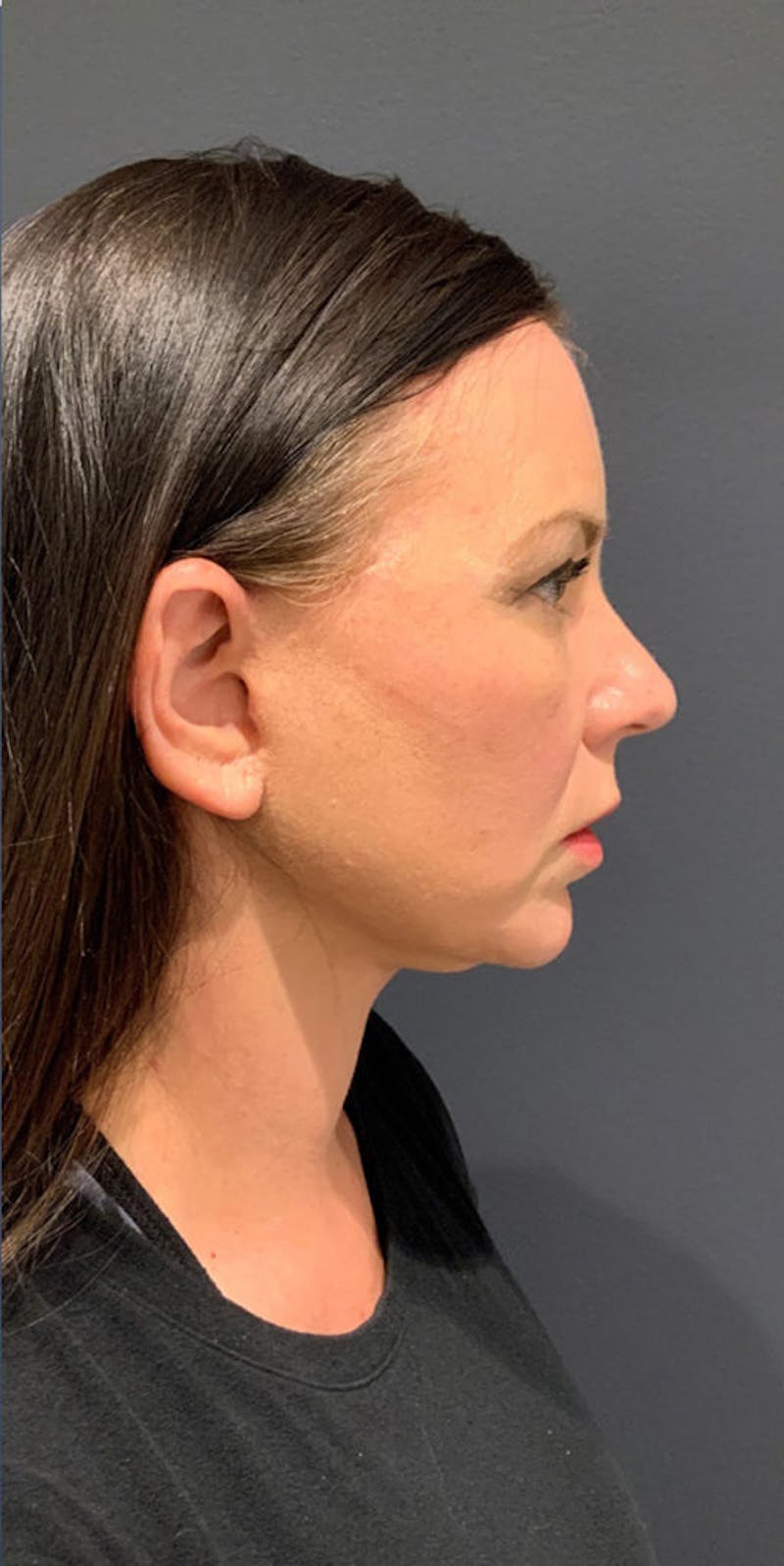 Facelift Before & After Gallery - Patient 147715 - Image 4