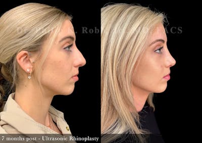 Ultrasonic Rhinoplasty Before & After Gallery - Patient 954732 - Image 1
