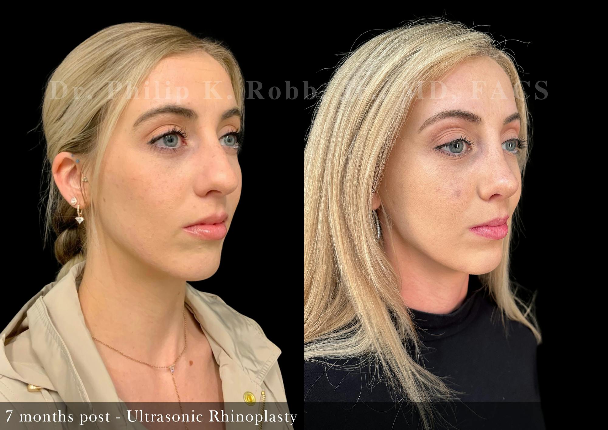 Ultrasonic Rhinoplasty Before & After Gallery - Patient 954732 - Image 2