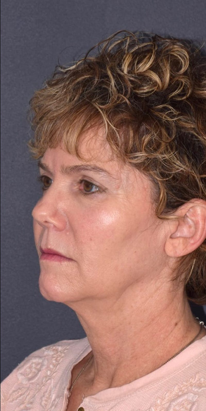Facelift Before & After Gallery - Patient 635847 - Image 3