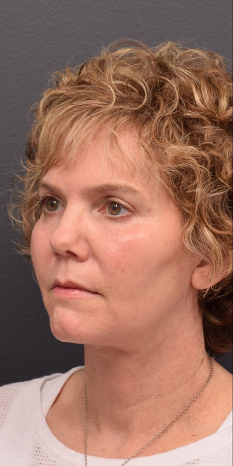 Facelift Before & After Gallery - Patient 635847 - Image 4