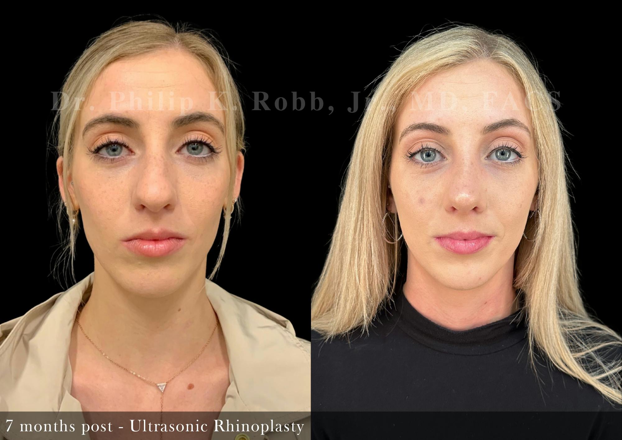 Ultrasonic Rhinoplasty Before & After Gallery - Patient 954732 - Image 4