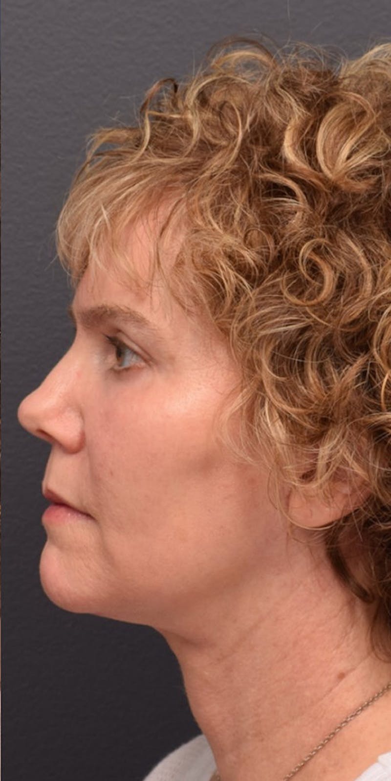 Facelift Before & After Gallery - Patient 635847 - Image 6