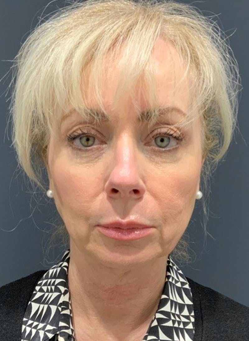 Facelift Before & After Gallery - Patient 200014 - Image 1