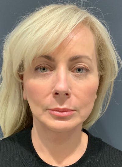 Facelift Before & After Gallery - Patient 200014 - Image 2