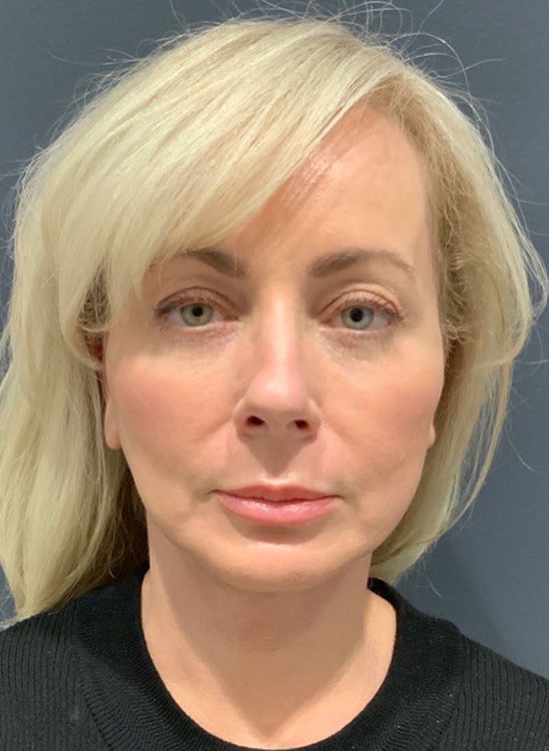 Facelift Before & After Gallery - Patient 200014 - Image 2