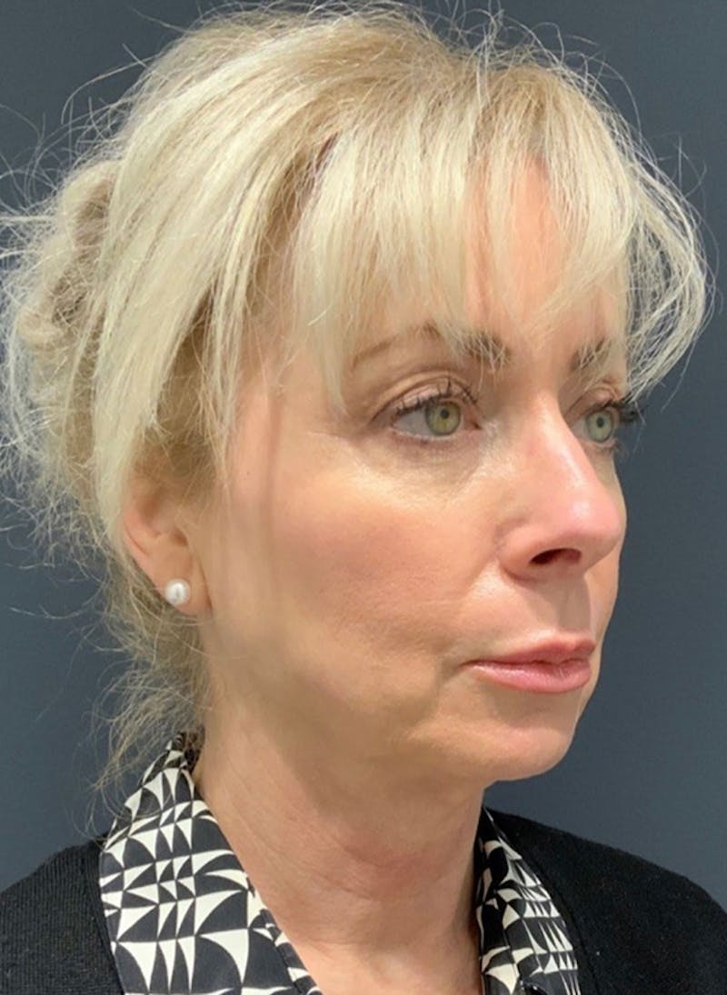 Facelift Before & After Gallery - Patient 200014 - Image 3