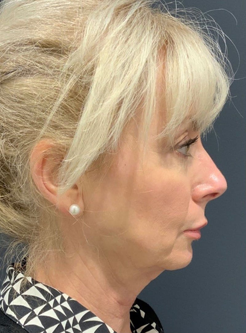Facelift Before & After Gallery - Patient 200014 - Image 5