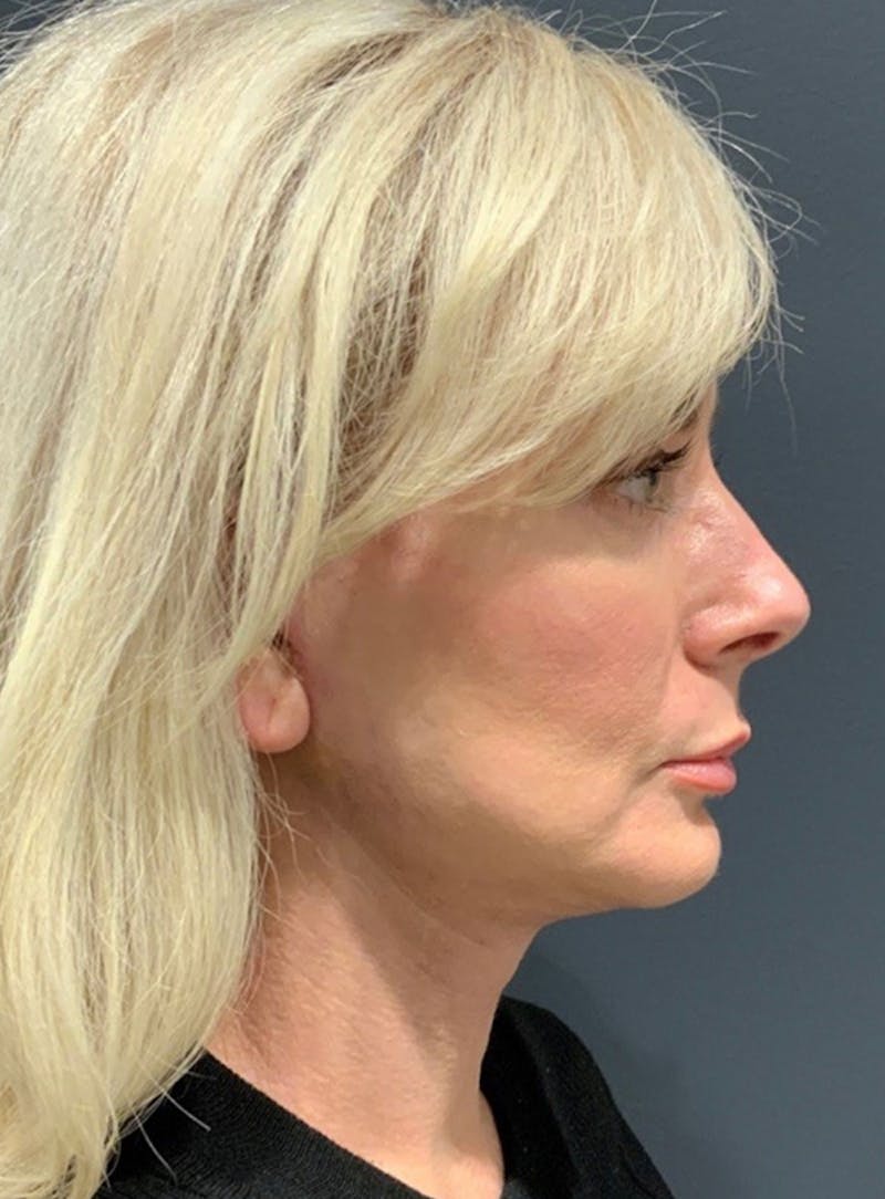 Facelift Before & After Gallery - Patient 200014 - Image 6