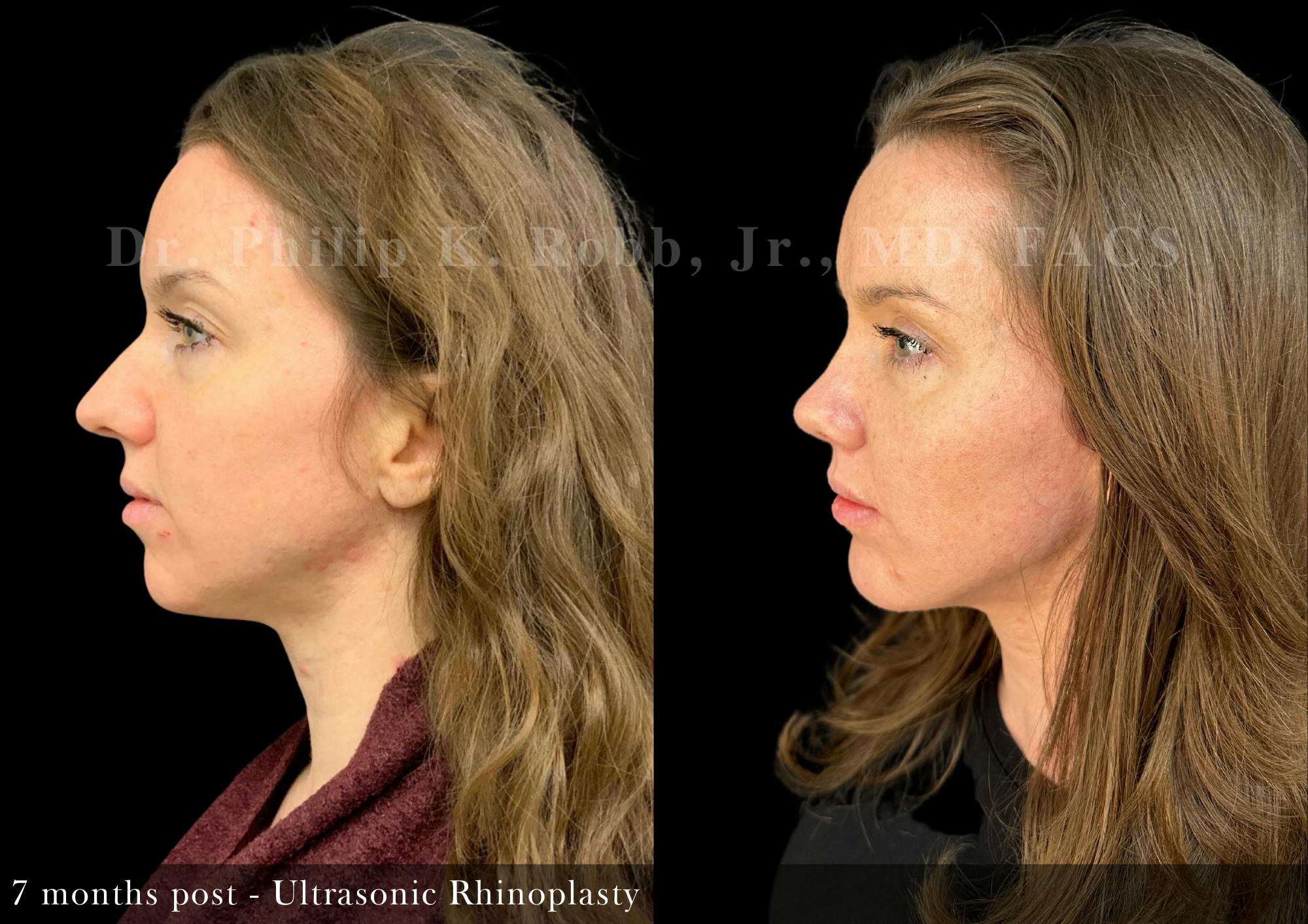 Ultrasonic Rhinoplasty Before & After Gallery - Patient 416842 - Image 2