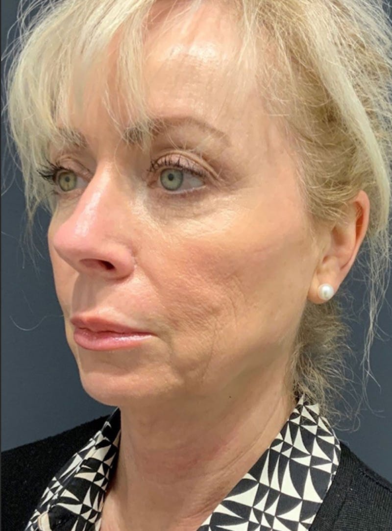 Facelift Before & After Gallery - Patient 200014 - Image 7
