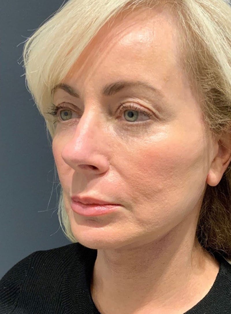 Facelift Before & After Gallery - Patient 200014 - Image 8