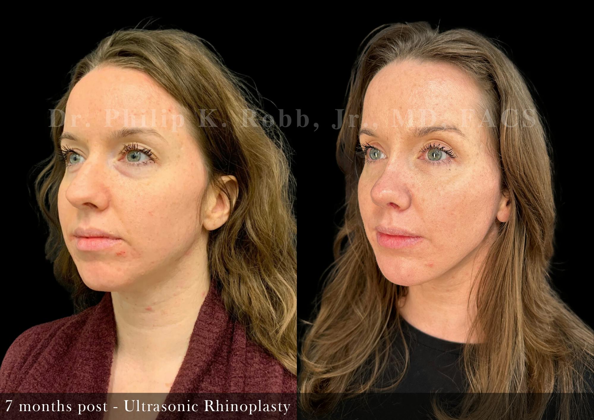 Ultrasonic Rhinoplasty Before & After Gallery - Patient 416842 - Image 3