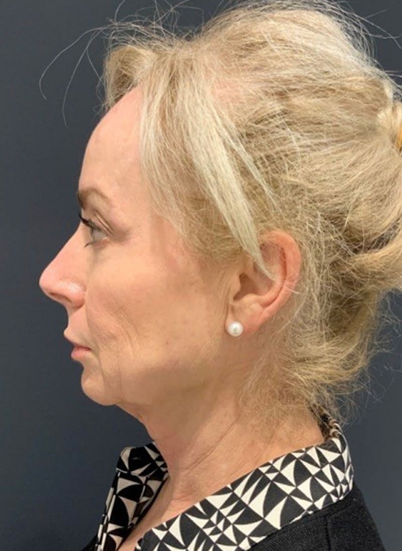 Facelift Before & After Gallery - Patient 200014 - Image 9