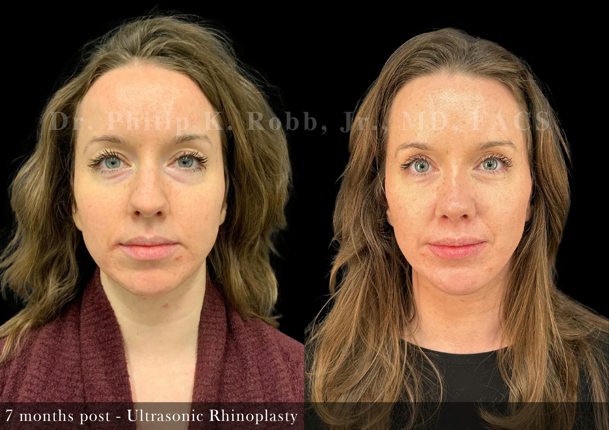 Ultrasonic Rhinoplasty Before & After Gallery - Patient 416842 - Image 4