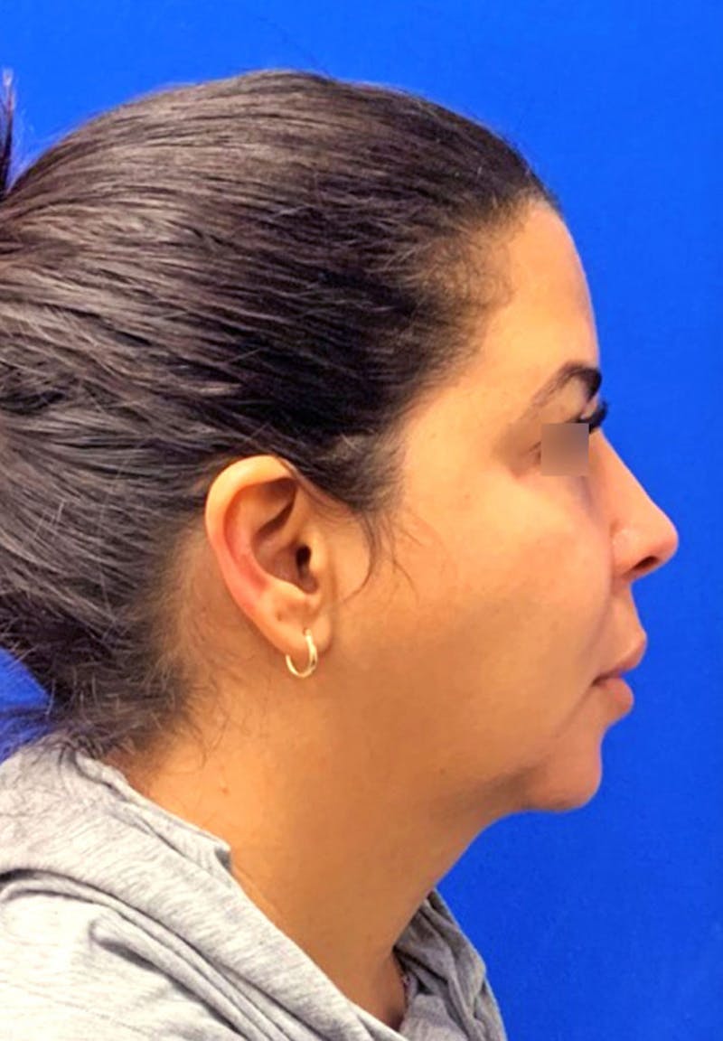 Facelift Before & After Gallery - Patient 232315 - Image 1