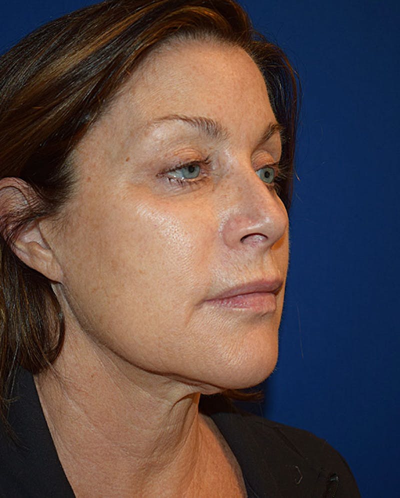 Facelift Before & After Gallery - Patient 551129 - Image 3