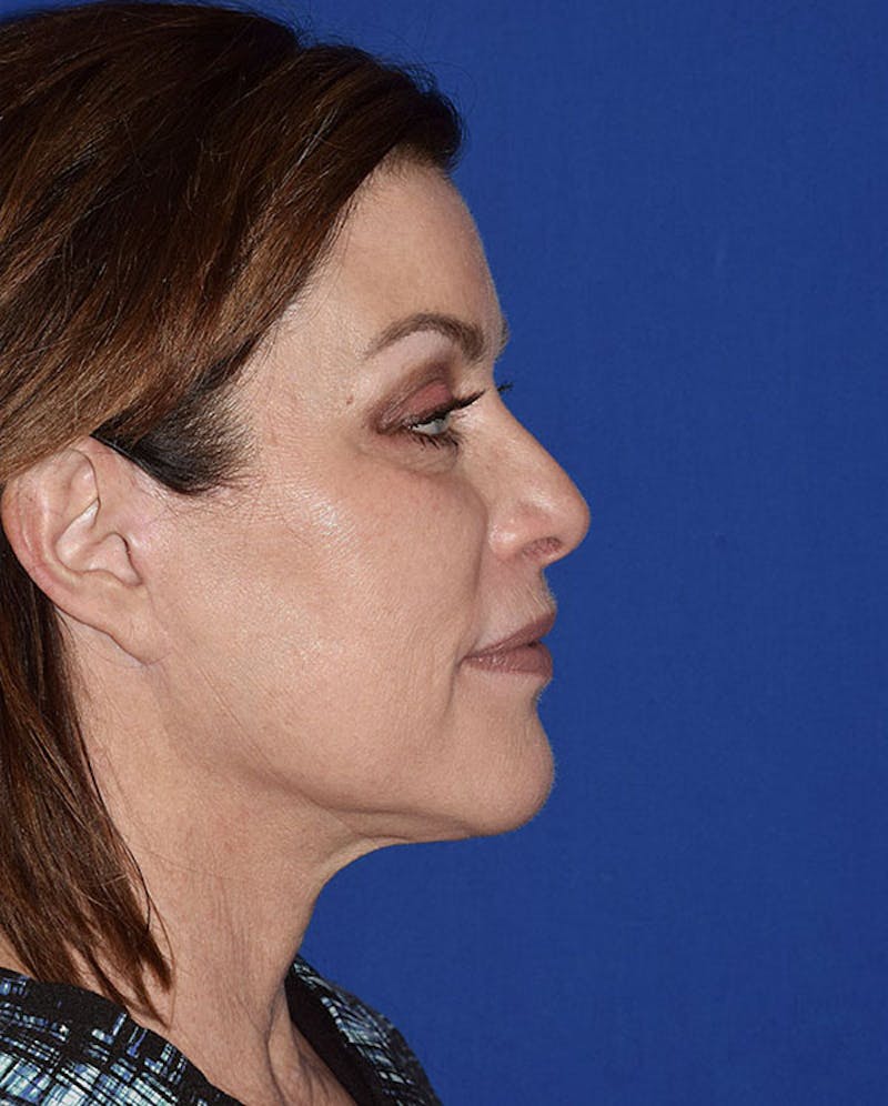 Facelift Before & After Gallery - Patient 551129 - Image 6