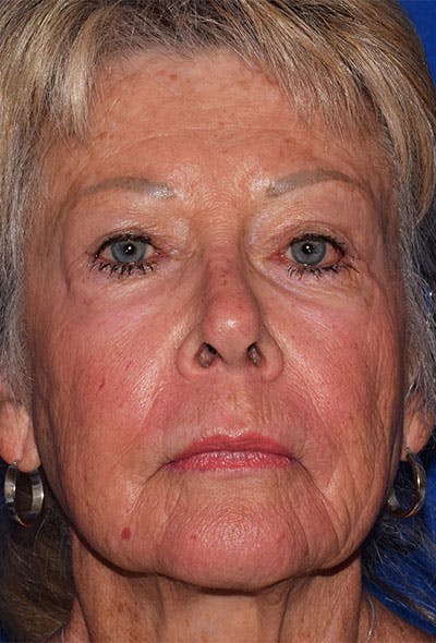 Facelift Before & After Gallery - Patient 105861 - Image 1