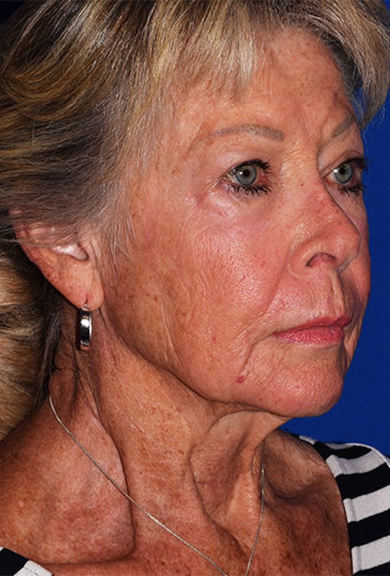 Facelift Before & After Gallery - Patient 105861 - Image 5