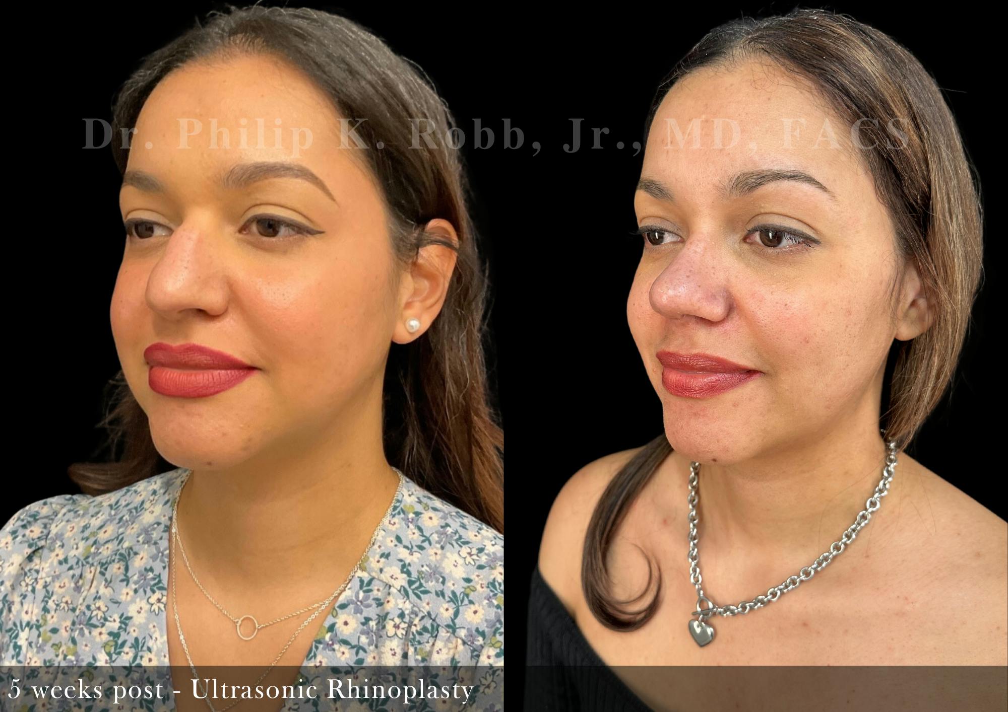 Ultrasonic Rhinoplasty Before & After Gallery - Patient 264061 - Image 3