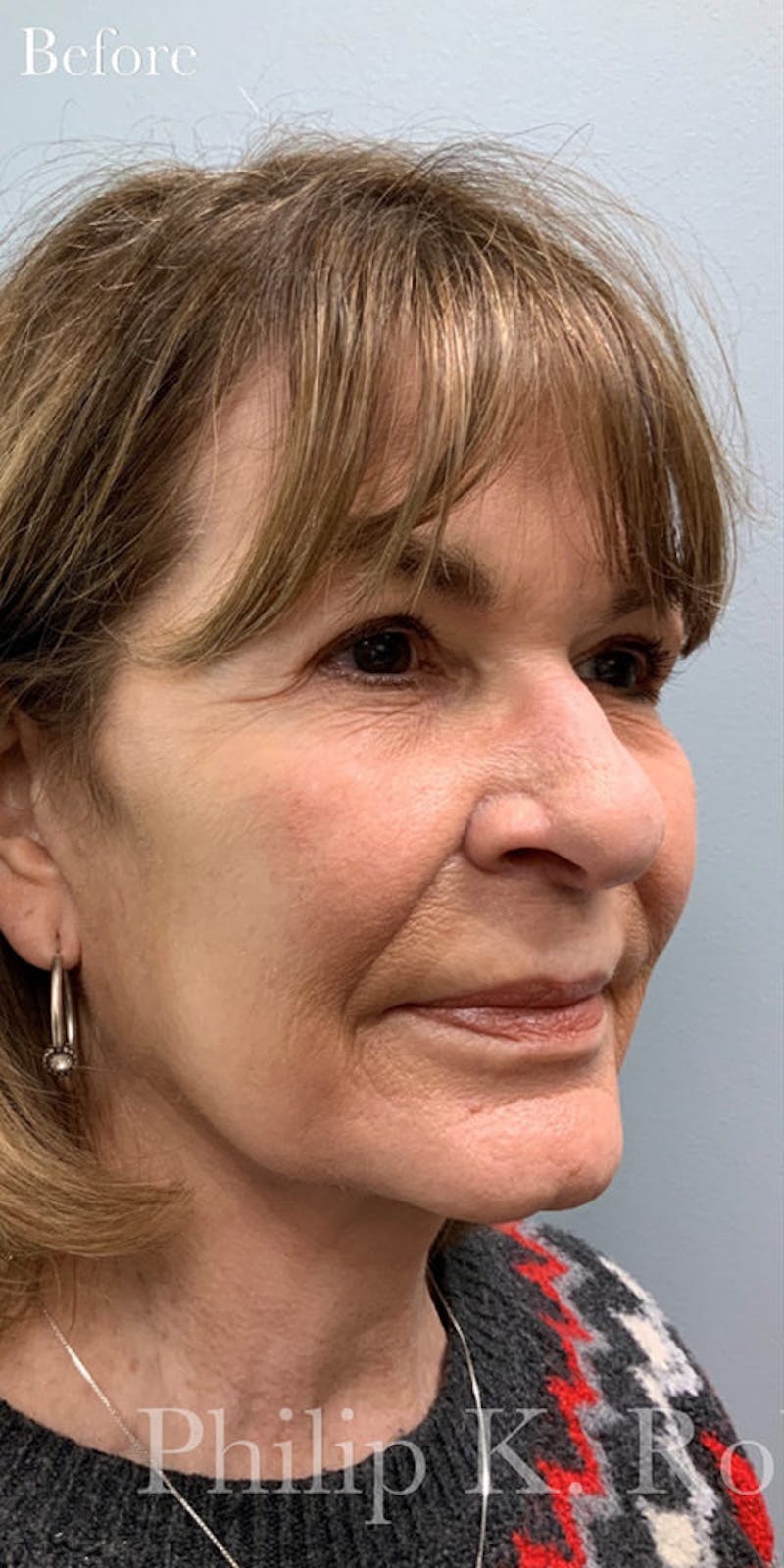 Facelift Before & After Gallery - Patient 268988 - Image 3
