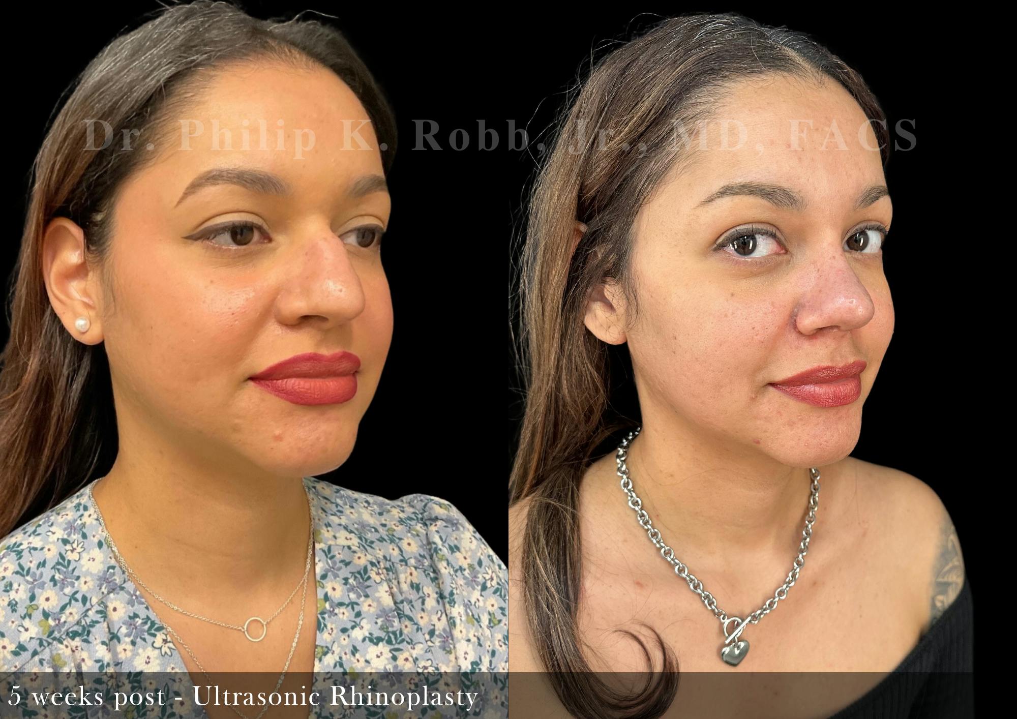 Ultrasonic Rhinoplasty Before & After Gallery - Patient 264061 - Image 5