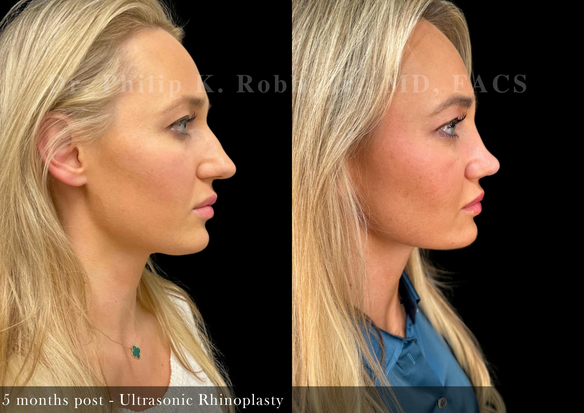 Ultrasonic Rhinoplasty Before & After Gallery - Patient 189943 - Image 1