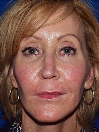 Facelift Before & After Gallery - Patient 361380 - Image 1