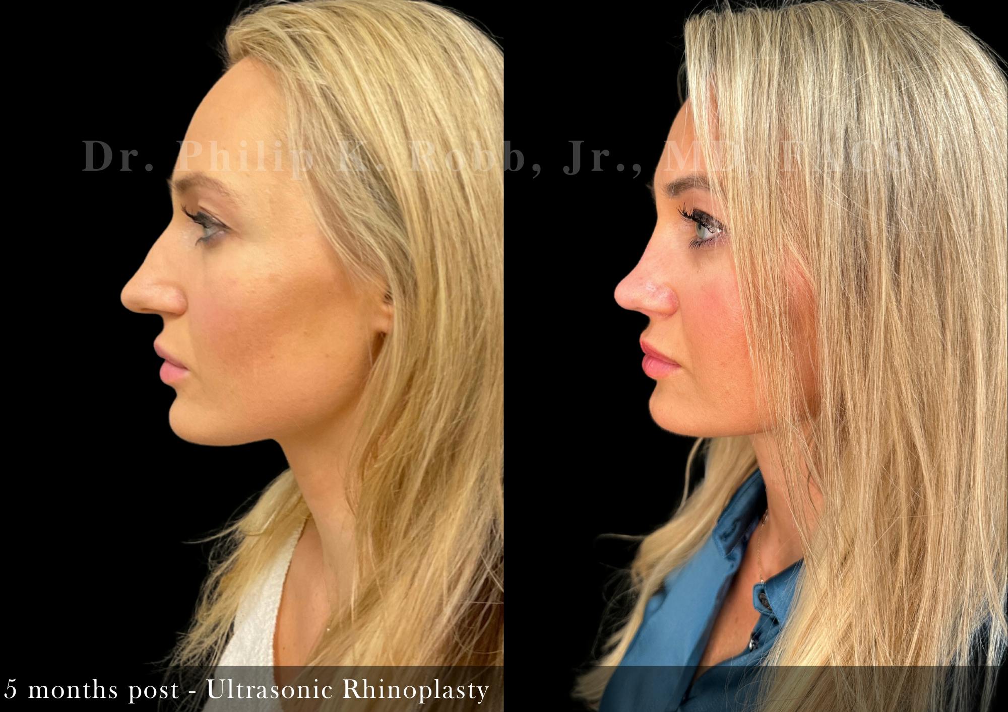 Ultrasonic Rhinoplasty Before & After Gallery - Patient 189943 - Image 2