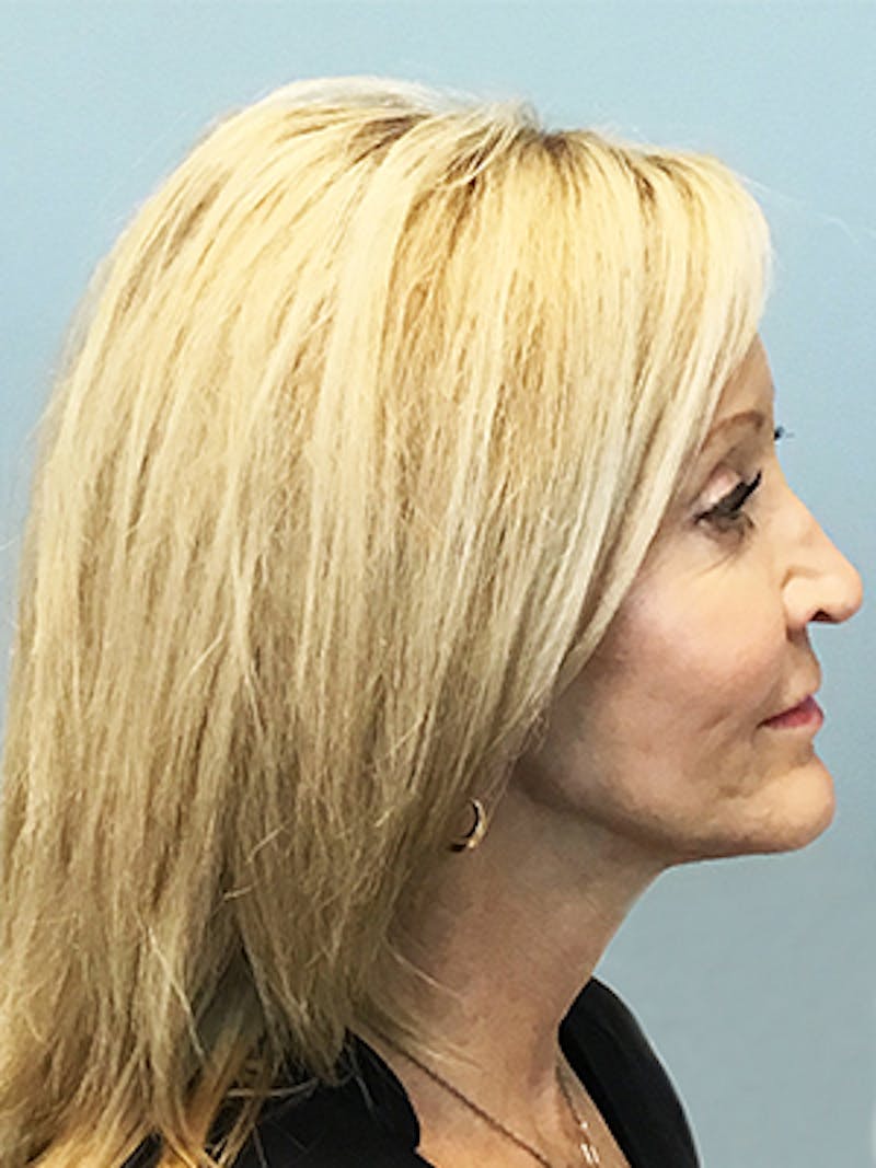 Facelift Before & After Gallery - Patient 361380 - Image 4