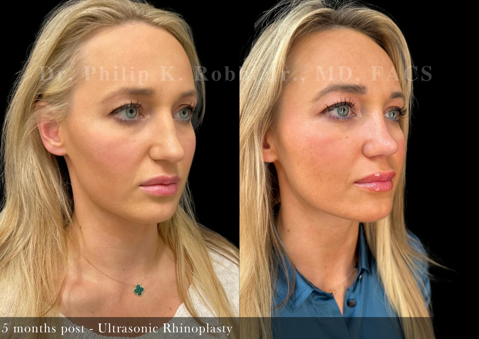 Ultrasonic Rhinoplasty Before & After Gallery - Patient 189943 - Image 3